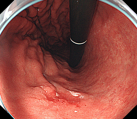粘膜下層浸潤のある早期胃がん
