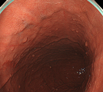 多発する胃底腺ポリープ