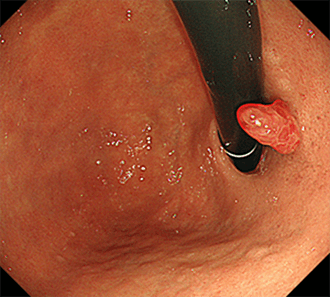 胃過形成性ポリープ