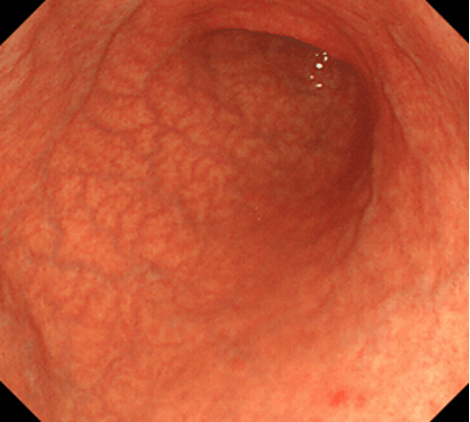 胃体部大弯の粘膜萎縮