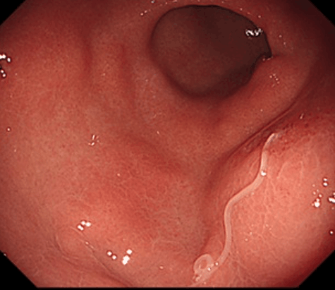 症状のある胃アニサキス症
