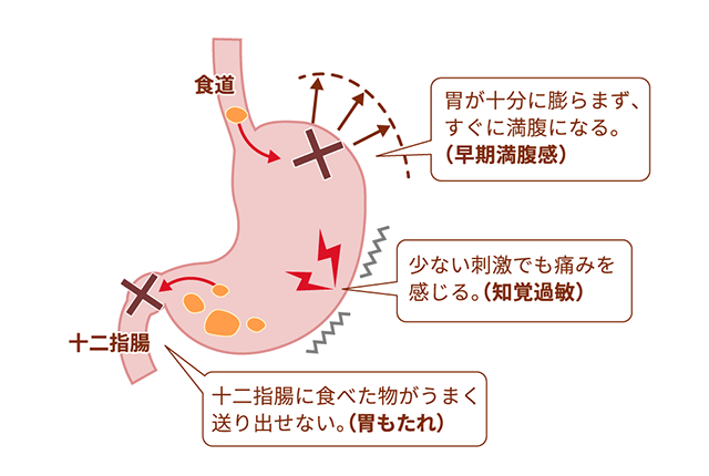 機能性ディスペプシア（FD）の症状と仕組みの説明図