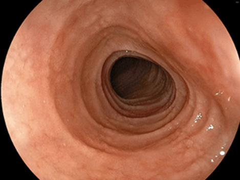 縦走溝・輪状溝の見られる好酸球性食道炎