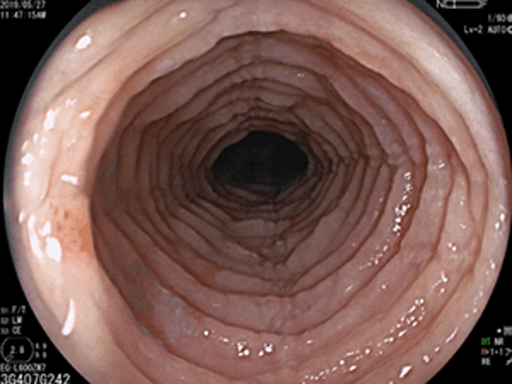 所見が強く気管様に観察されるEoE