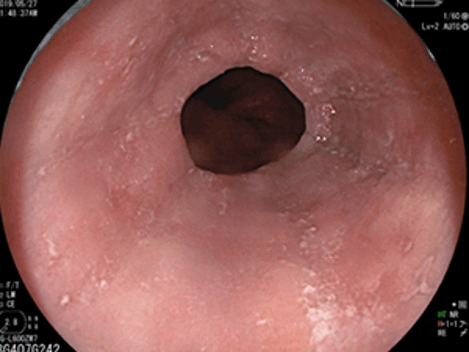 縦走溝・軽度白斑の状態に改善