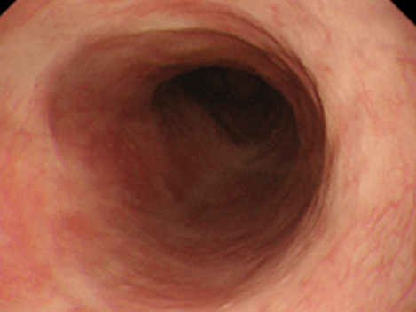 治癒して瘢痕化