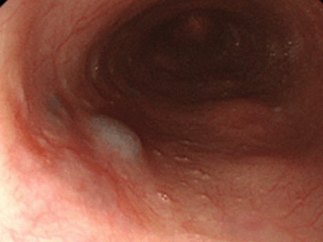 中部食道に局在する孤立性静脈拡張