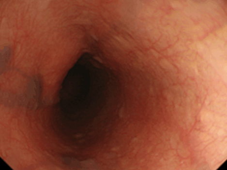 孤立性静脈拡張