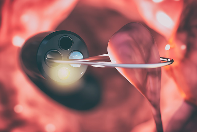 ポリープイメージ