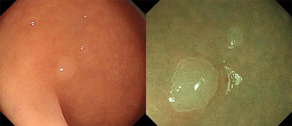 大腸過形成性ポリープ（右はNBI併用拡大観察像）