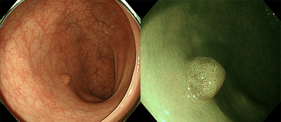 大腸腺腫（右はNBI併用拡大観察像）