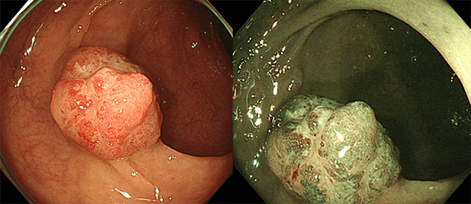 進行大腸がん（右はNBI観察像）