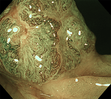 大腸がんの病変
