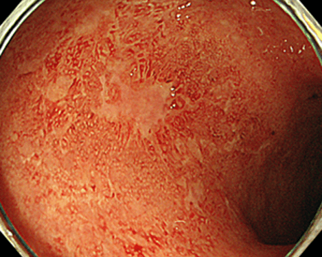 よりも炎症の活動性が高く、潰瘍を認める潰瘍性大腸炎