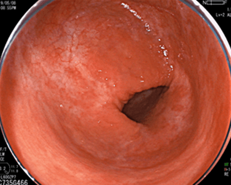 激しい炎症が治癒した後の瘢痕