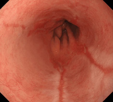 食道裂孔ヘルニアに伴った逆流性食道炎