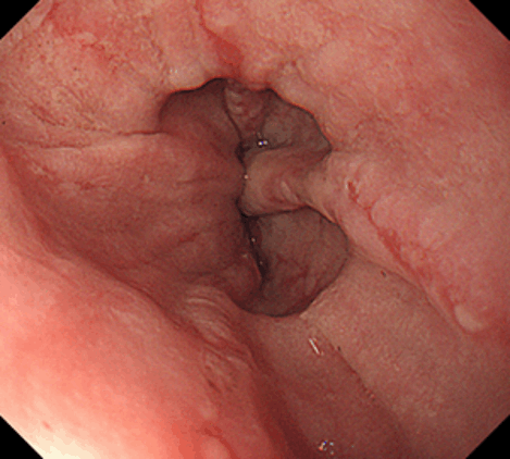 グレードBの逆流性食道炎