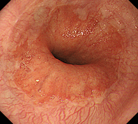 逆流性食道炎が治癒した状態