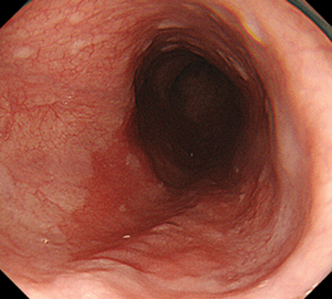 部中部食道に主座を持つ扁平上皮癌