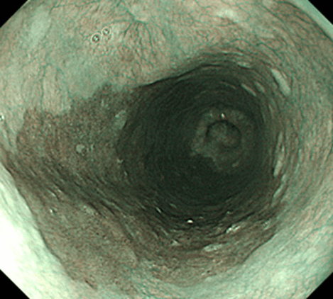 NBI観察によって病変が明瞭化