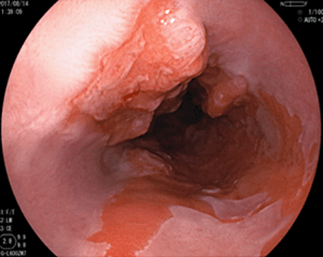 バレット腺がん